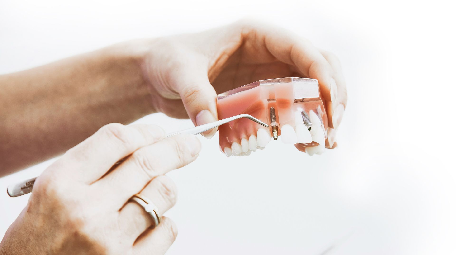 Hände halten ein Zahnmodell, eine Hand hält eine Pinzette, die auf einen Zahn mit Implantat zeigt